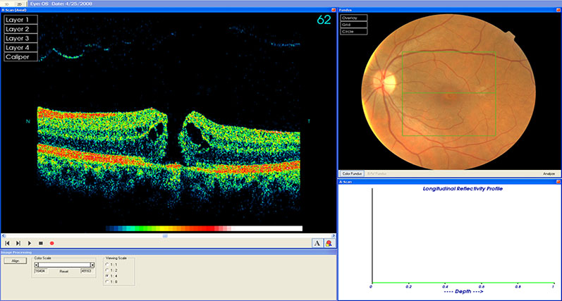 Macular Hole Repair