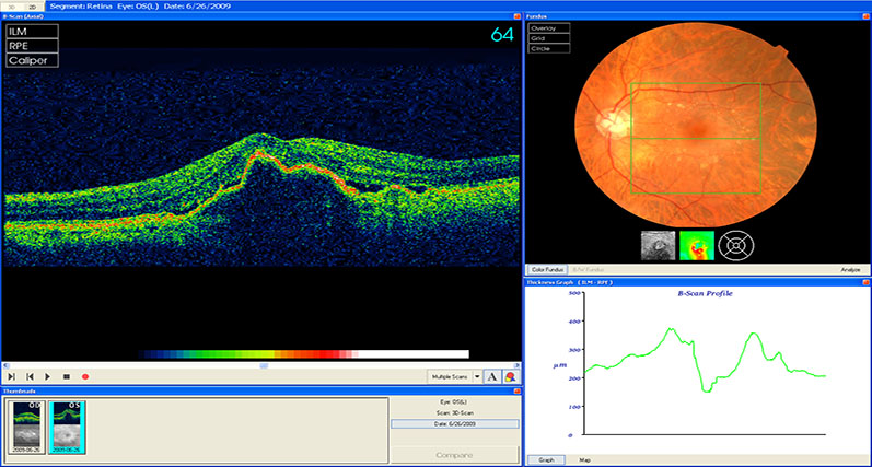 Macular Degeneration